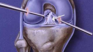 Anterior Cruciate Ligament (ACL) Repair