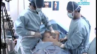 Corrección de síndrome de Poland con lipotransferencia