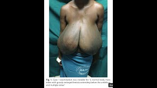 GiGAntomastia REDUCTION MAMMOPLASTY