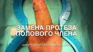 Penile prosthesis reimplantation. Surgeon: Konstantin Menshchikov