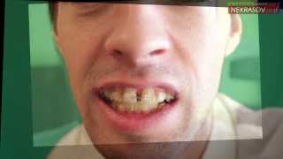 шоу NEKRASOV TV брекеты 1day with BRACES inspire / 3 month later with braces inspire!