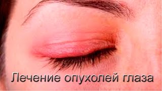 Виофтаны и виоргоны при опухолевых процессах в глазу. Краснов М С