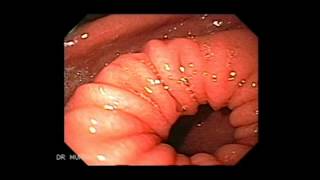 Upper Gastrointestinal Endoscopy
