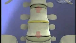 Лечение позвоночника.  Восстановления межпозвонковых дисков DRX 9000™ Spinal Decompression Machine.