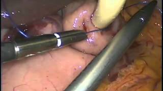 Gastrostomy - Videolaparoscopy