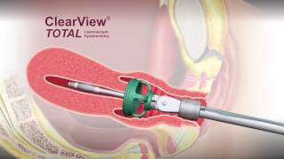 ClearView® TOTAL Uterine Manipulator - Animation