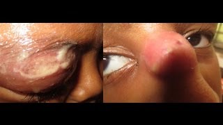 Abscess Near Eyes + Cellulitis of Eye