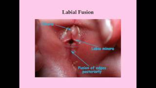 Congenital Disorders of the Lower Reproductive Tract - CRASH! Medical Review Series