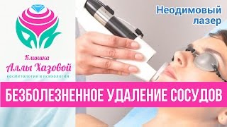 Неодимовый лазер. Удаление сосудистых звездочек лазером. Лазерное лечение акне. Сосудистые сеточки.