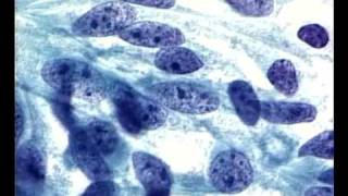 Szalay Tutorial part 2 : Cervical Pathalogy, Colposcopy and Cytology. Szalay Pap test device.