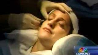 Eyelash Transplant - Miami TV