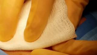 Gigantic oozing sore. Surgical treatment.