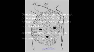 ВАТС резекция бул при пневмотораксе (РНЦХ)