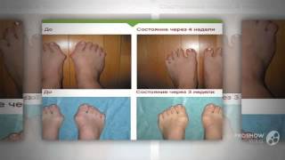 valgus pro отзывы

  - Фиксатор Valgus Plus