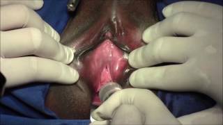 Micro sling