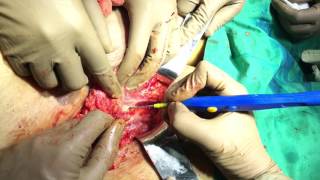 InguinoFemoral Lymphadenectomy for Cancer Vulva- Dr Jay Mehta