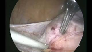 TLH 2 lbs uterus