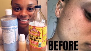 Apple Cider Vinegar Face Wash | Get Rid Of Acne And Dark Spots | Super Easy