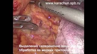 Laparoscopic Distal Pancreatectomy
