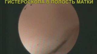 Спираль внутриматочная. Удаление.