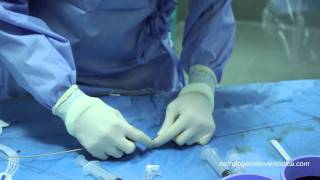 FAV angioplastica PTA stenosi venosa - Nefrologia - interventional nephrology - AVF fistula dialysis