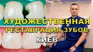 Реставрация зубов наращивание Киев Люми-Дент (видео)
