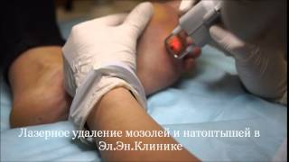 Удаление мозолей и натоптышей лазером
