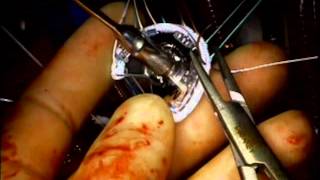 Mitral Valve Repair