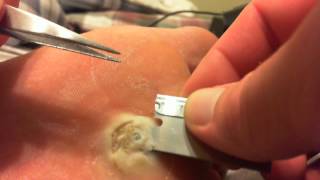 Plantars Wart Removal
