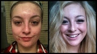 End of Accutane! Before and After