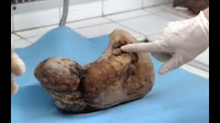 Người phụ nữ mang bầu suốt 46 năm không đẻ, lúc mo lấy bác sĩ choáng váng