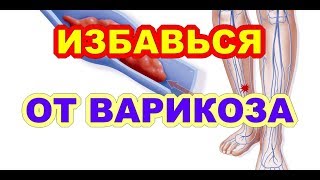 Крем От Варикоза, Какой Выбрать И Как Применять