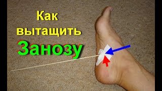Как легко вытащить занозу. Удаление занозы у взрослых и детей. Достать ее быстро