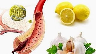 Как очистить сосуды Головного Мозга? Чистка сосудов. Холестерин. Атеросклероз