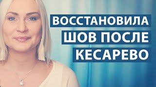 ВОССТАНОВЛЕНИЕ ШВА ПОСЛЕ РОДОВ - КЕСАРЕВО СЕЧЕНИЕ