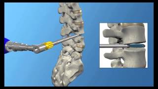 Gobus Medical: RISE®