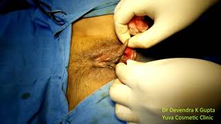 Bartholin's Cyst Abscess