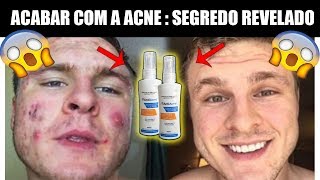 Antiacne Funciona ?Antiacne vale a pena comprar ? Meu depoimento