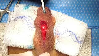Urethrocutaneous fistula closure after hypospadias repair