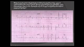 ST სეგმენტის დეპრესია (დიგოქსინის ეფექტი) / ST segmentis depresia (digoqsini) /ქალამნისებრი დეპრესია