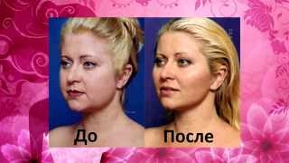 Плазмолифтинг для омоложения кожи Томилова А А