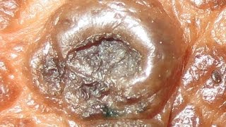 Favre Racouchot Syndrome
