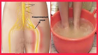 ЛУЧШИЙ РЕЦЕПТ Для Тех, КТО Страдает ЗАЩЕМЛЕНИЕМ Седалищного НЕРВА! Эффект После ПЕРВОЙ ПРОЦЕДУРЫ!
