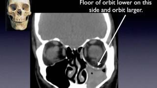 The silent sinus syndrome movie Terrell