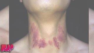 Teen Dies From His Girlfriend's Hickey