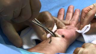 Endoscopic carpal tunnel surgery . Carpale tunnel syndroom: kijkoperatie.