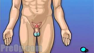 Vasectomy Surgery of the Penis, PreOp® Patient Education Medical