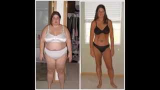 Antes e depois cirurgia bariátrica - especial redução de estômago.