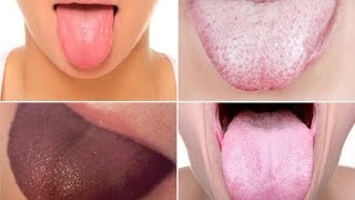 ШОК!!!!Болезни, о которых расскажет ваш язык