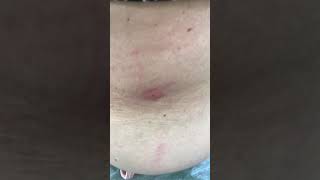Как помочь себе при укусах насекомых. Эффекты щёлочи и метода мгновенного исцеления.